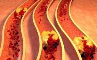 高血脂的天敌是什么？医生一次告诉您，忠言逆耳，从不忽悠 