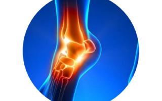 健身跑为何膝肿痛 原是骨膜发炎作祟